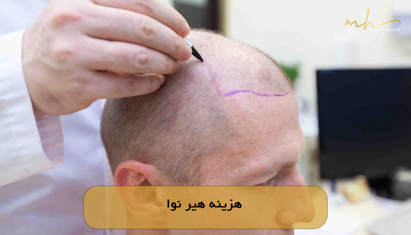 هزینه هیر نوا