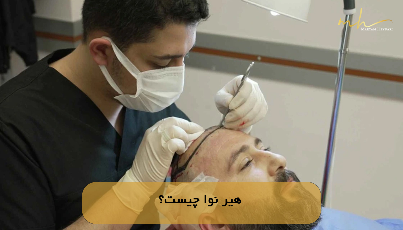 هیر نوا چیست؟