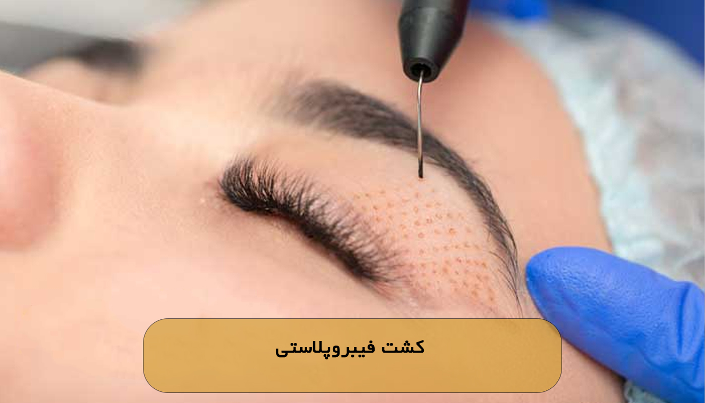 کشت فیبروپلاستی