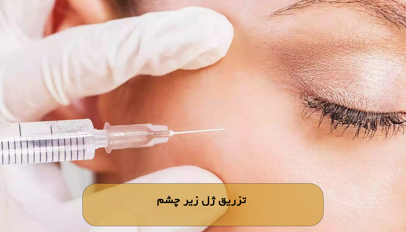 تزریق ژل زیر چشم