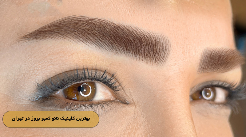 بهترین کلینیک نانو کمبو بروز در تهران