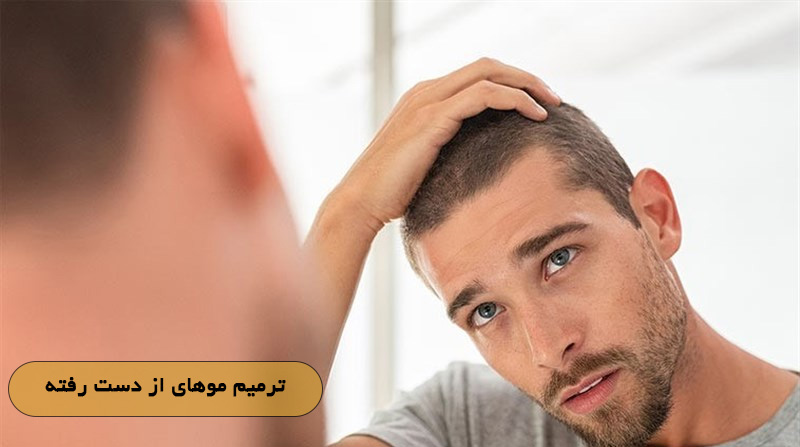 ترمیم موهای از دست رفته