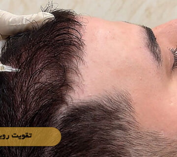 تقویت رویش مو