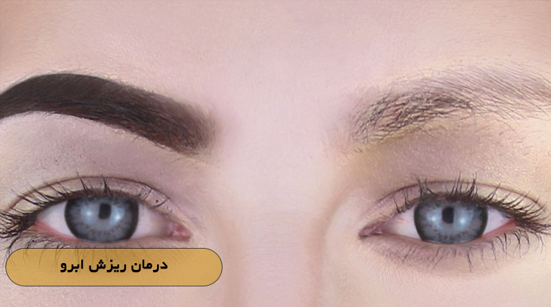 درمان ریزش ابرو