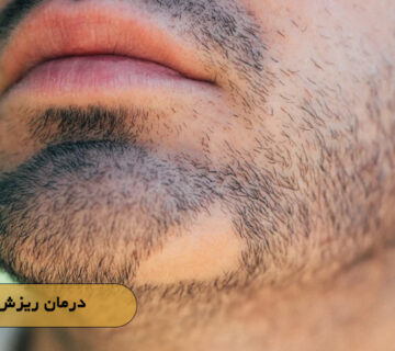 درمان ریزش سکه‌ای