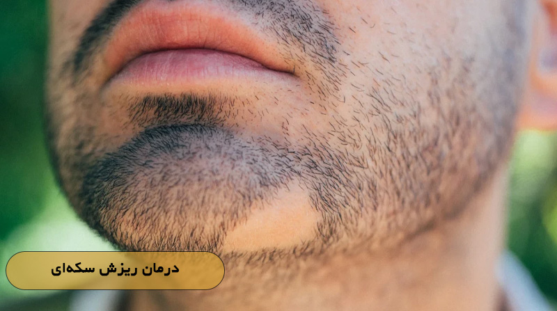 درمان ریزش سکه‌ای