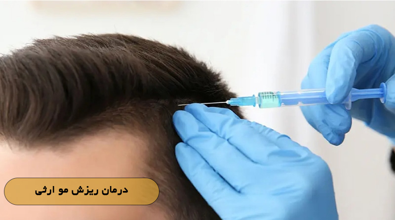 درمان ریزش مو ارثی