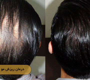 درمان ریزش مو بدون جراحی