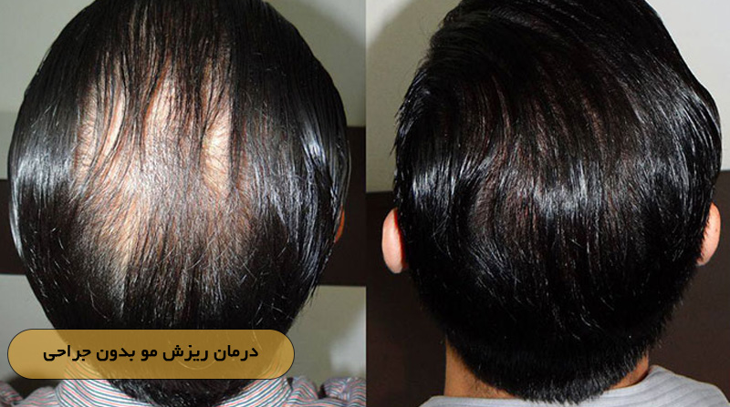 درمان ریزش مو بدون جراحی