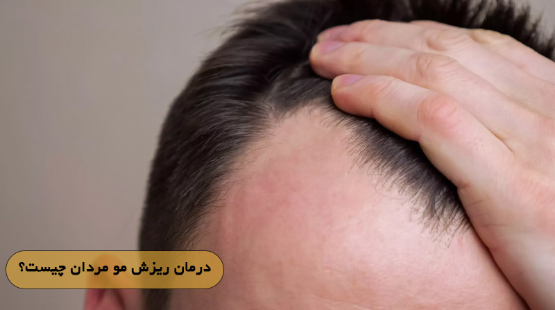 درمان ریزش مو مردان چیست؟