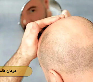 درمان طاسی سر