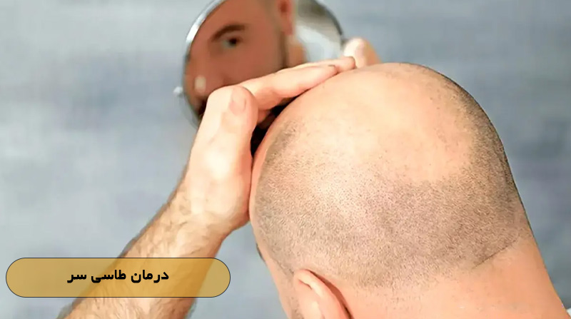 درمان طاسی سر