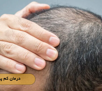 درمان کم پشتی مو