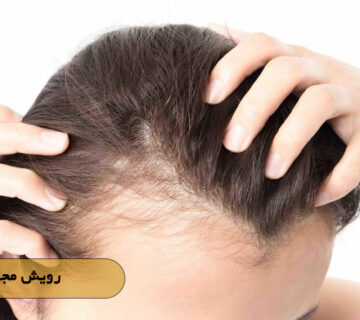 رویش مجدد مو