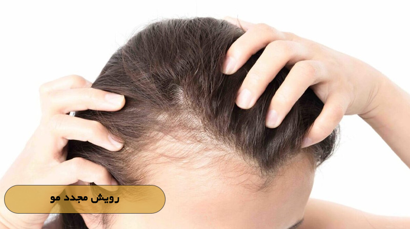 رویش مجدد مو