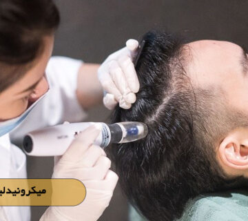 میکرونیدلینگ مو