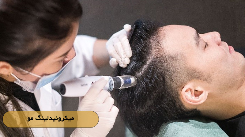 میکرونیدلینگ مو