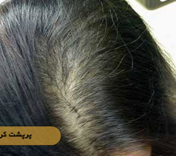 پرپشت کردن مو