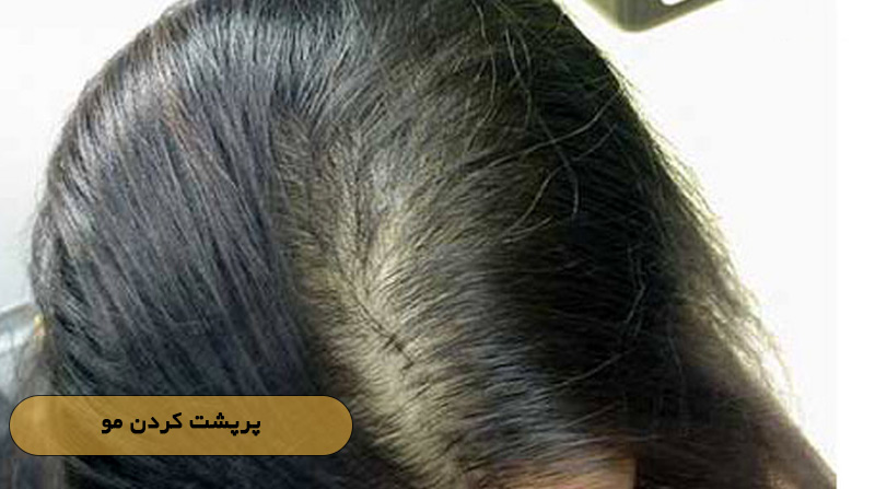 پرپشت کردن مو