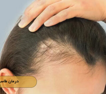 درمان طاسی ارثی