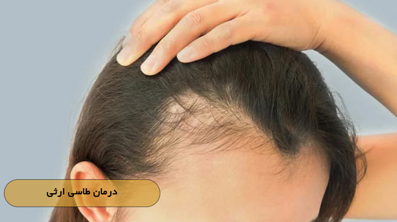 درمان طاسی ارثی