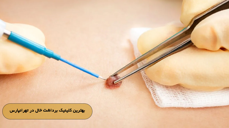 بهترین کلینیک برداشت خال در تهرانپارس