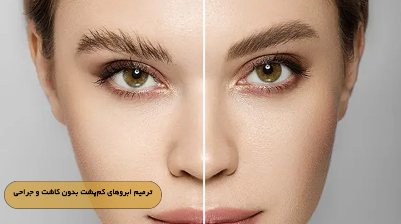 ترمیم ابروهای کم‌پشت بدون کاشت و جراحی