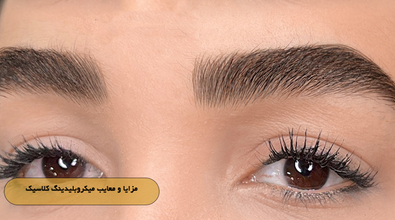 مزایا و معایب میکروبلیدینگ کلاسیک