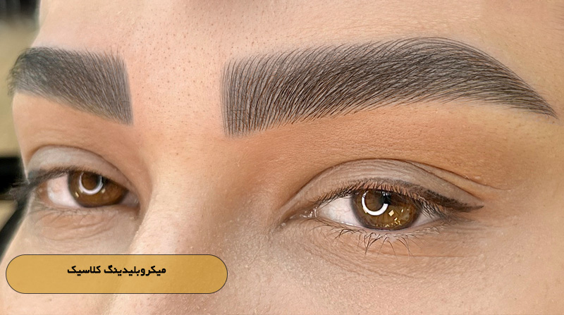 میکروبلیدینگ کلاسیک