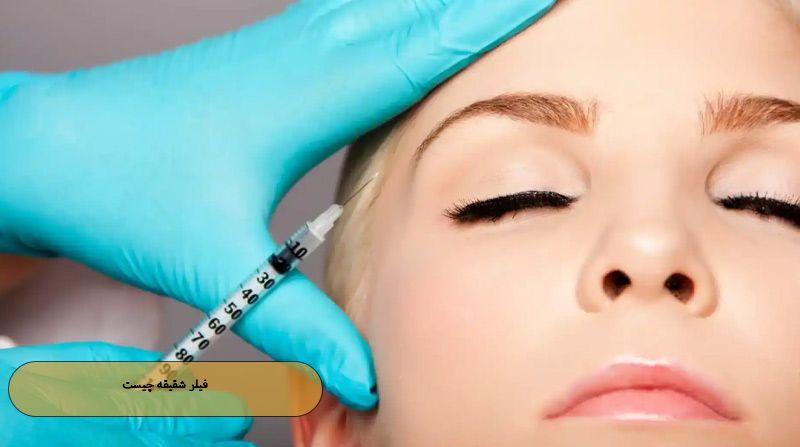 فیلر شقیقه چیست