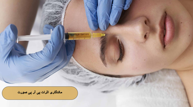 مدت زمان ماندگاری اثرات پی آر پی صورت چقدر است؟