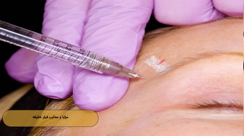 مزایا و معایب فیلر شقیقه