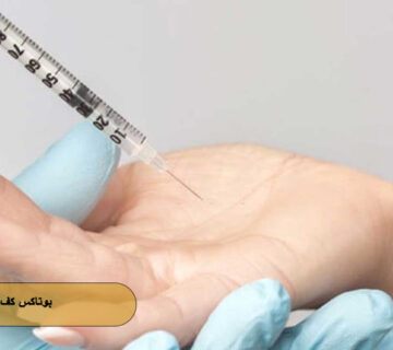 بوتاکس کف دست