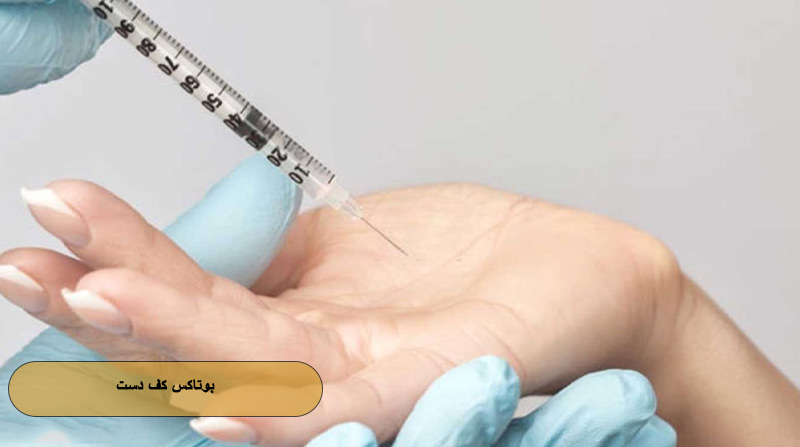 بوتاکس کف دست