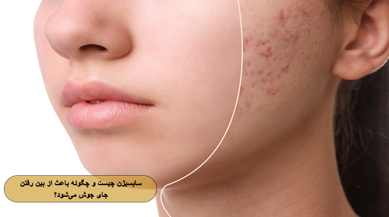 سابسیژن چیست و چگونه باعث از بین رفتن جای جوش می‌شود؟