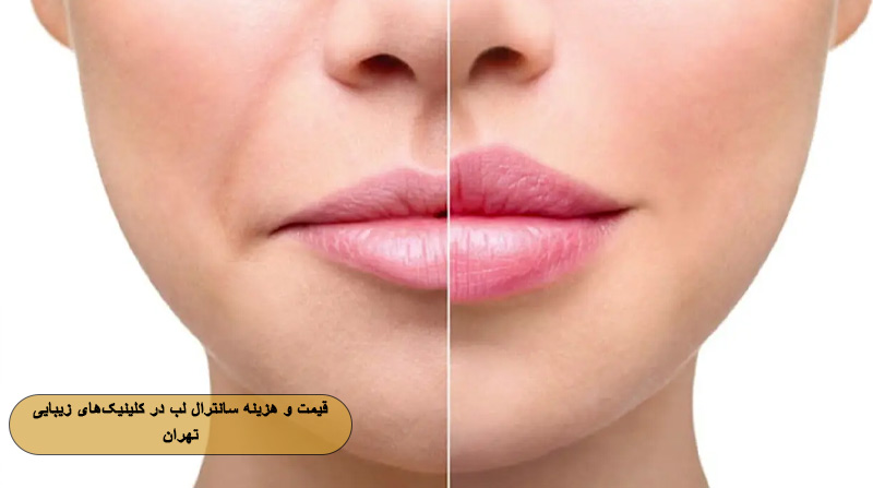 قیمت و هزینه سانترال لب در کلینیک‌های زیبایی تهران