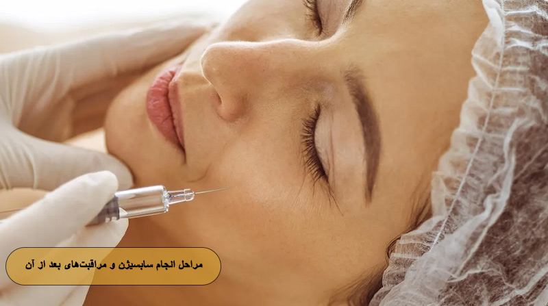 مراحل انجام سابسیژن و مراقبت‌های بعد از آن