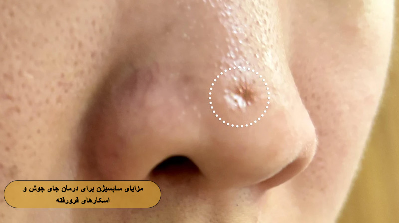 مزایای سابسیژن برای درمان جای جوش و اسکارهای فرورفته