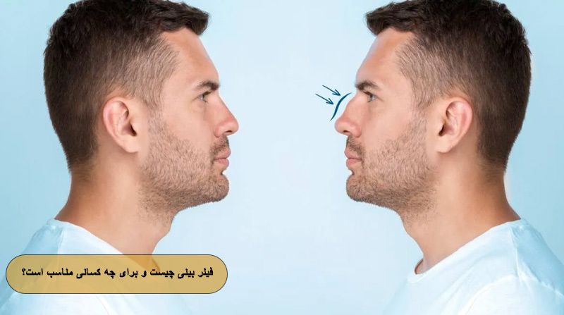 فیلر بینی چیست و برای چه کسانی مناسب است؟