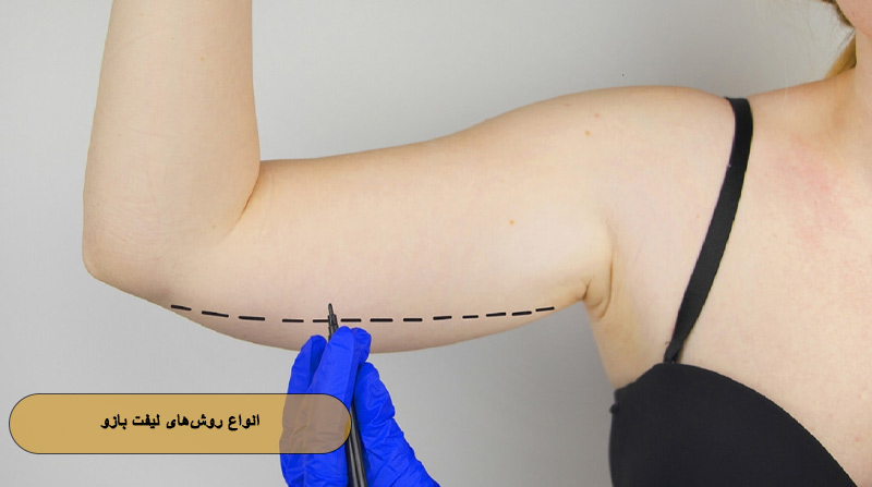 انواع روش‌های لیفت بازو