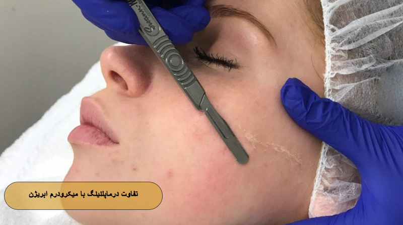 تفاوت درماپلنینگ با میکرودرم ابریژن
