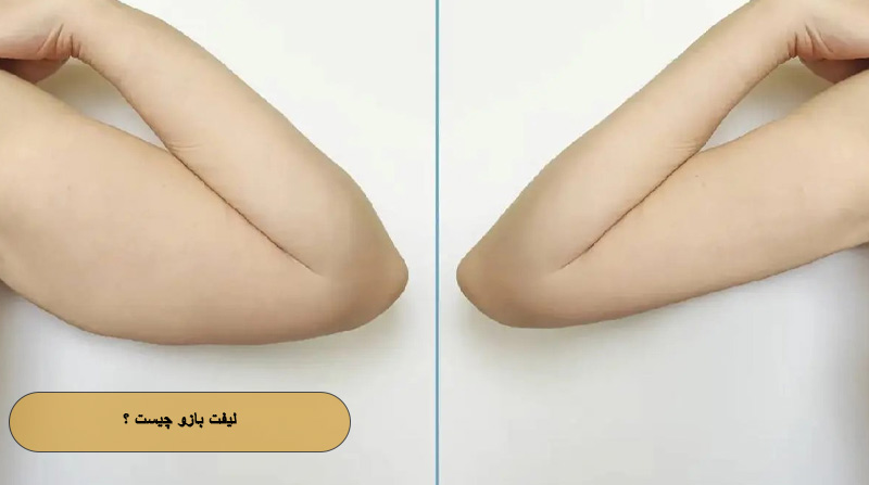 لیفت بازو چیست ؟