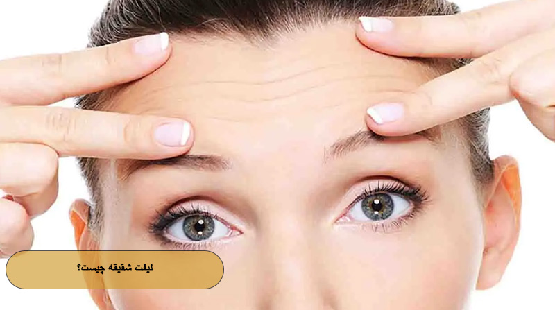 لیفت شقیقه چیست؟