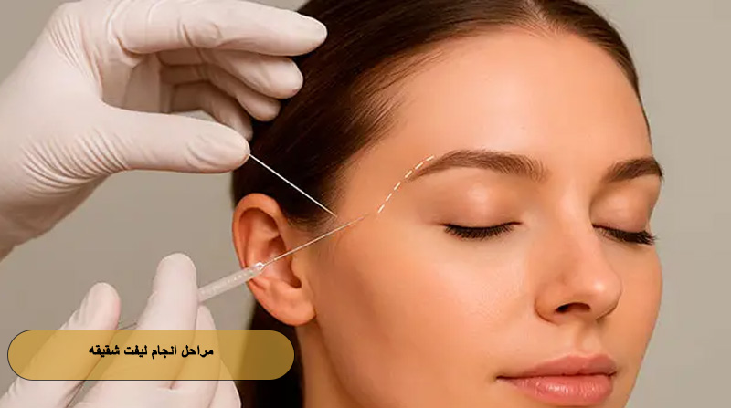 مراحل انجام لیفت شقیقه