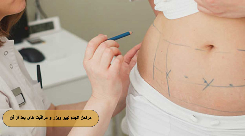 مراحل انجام لیپو ویزر و مراقبت ‌های بعد از آن