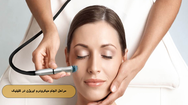 مراحل انجام میکرودرم ابریژن در کلینیک