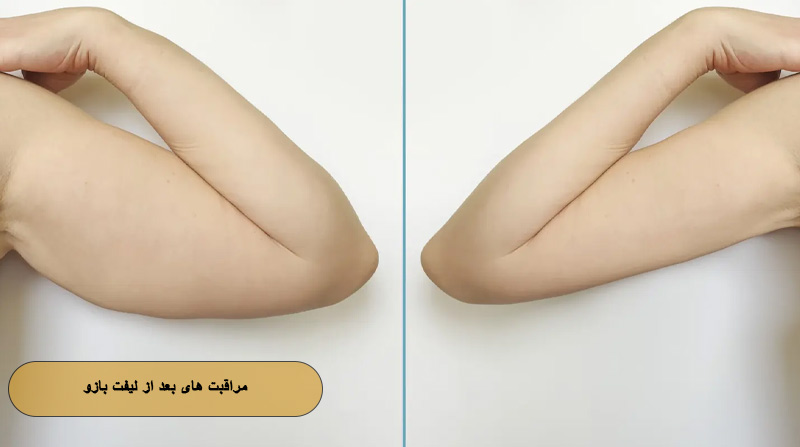 مراقبت‌ های بعد از لیفت بازو