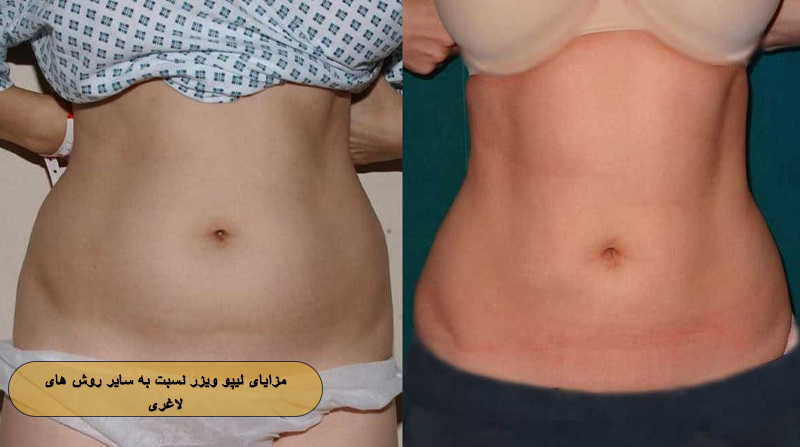 مزایای لیپو ویزر نسبت به سایر روش‌ های لاغری