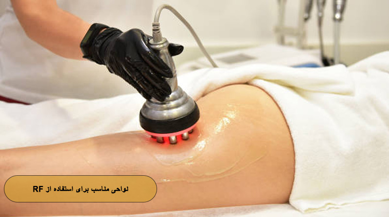 نواحی قابل درمان با  RF Cavitation