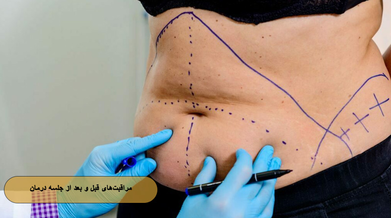 مراقبت‌های قبل و بعد از جلسه درمان